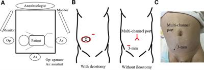 Laparoscopic restorative proctocolectomy with ileal-J-pouch anal canal anastomosis without diverting ileostomy for total colonic and extensive aganglionosis is safe and feasible with combined Lugol's iodine staining technique and indocyanine green fluorescence angiography